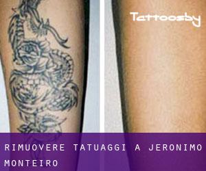 Rimuovere Tatuaggi a Jerônimo Monteiro