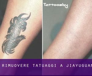 Rimuovere Tatuaggi a Jiayuguan