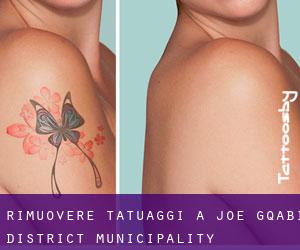 Rimuovere Tatuaggi a Joe Gqabi District Municipality