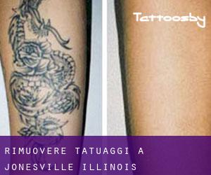 Rimuovere Tatuaggi a Jonesville (Illinois)