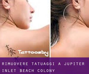 Rimuovere Tatuaggi a Jupiter Inlet Beach Colony