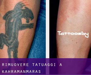 Rimuovere Tatuaggi a Kahramanmaraş