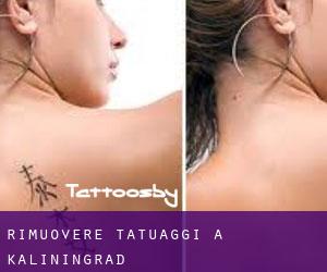 Rimuovere Tatuaggi a Kaliningrad