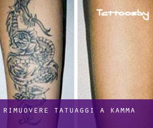 Rimuovere Tatuaggi a Kamma