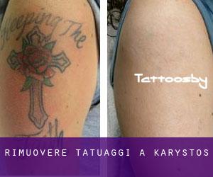Rimuovere Tatuaggi a Kárystos