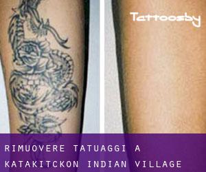 Rimuovere Tatuaggi a Katakitckon Indian Village