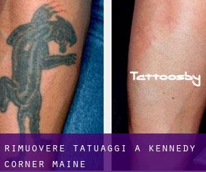 Rimuovere Tatuaggi a Kennedy Corner (Maine)