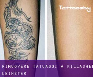 Rimuovere Tatuaggi a Killashee (Leinster)