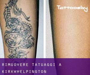 Rimuovere Tatuaggi a Kirkwhelpington