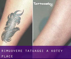Rimuovere Tatuaggi a Kotey Place