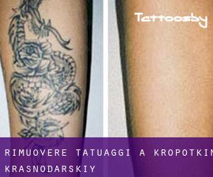 Rimuovere Tatuaggi a Kropotkin (Krasnodarskiy)