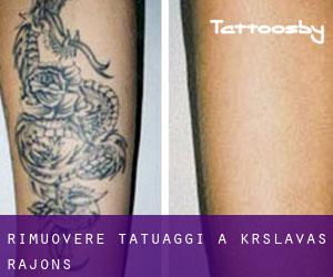 Rimuovere Tatuaggi a Krāslavas Rajons