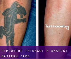 Rimuovere Tatuaggi a KwaPosi (Eastern Cape)