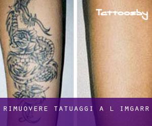 Rimuovere Tatuaggi a L-Imġarr