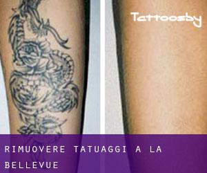 Rimuovere Tatuaggi a La Bellevue