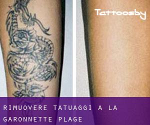 Rimuovere Tatuaggi a La Garonnette-Plage