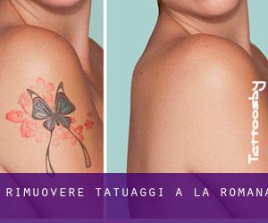 Rimuovere Tatuaggi a La Romana