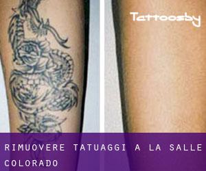 Rimuovere Tatuaggi a La Salle (Colorado)