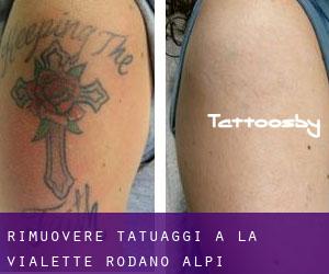 Rimuovere Tatuaggi a La Vialette (Rodano-Alpi)
