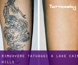 Rimuovere Tatuaggi a Lake Cain Hills