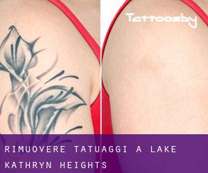 Rimuovere Tatuaggi a Lake Kathryn Heights