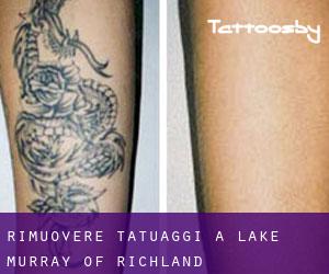 Rimuovere Tatuaggi a Lake Murray of Richland