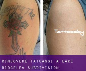 Rimuovere Tatuaggi a Lake Ridgelea Subdivision