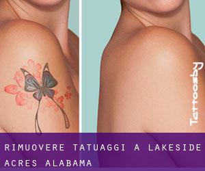 Rimuovere Tatuaggi a Lakeside Acres (Alabama)