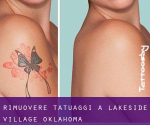 Rimuovere Tatuaggi a Lakeside Village (Oklahoma)