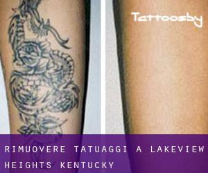 Rimuovere Tatuaggi a Lakeview Heights (Kentucky)