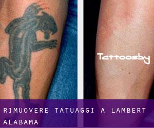 Rimuovere Tatuaggi a Lambert (Alabama)