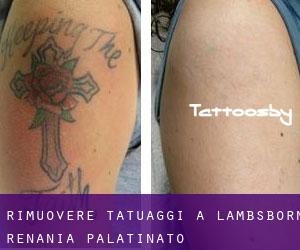 Rimuovere Tatuaggi a Lambsborn (Renania-Palatinato)