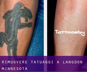 Rimuovere Tatuaggi a Langdon (Minnesota)