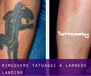Rimuovere Tatuaggi a Larneds Landing