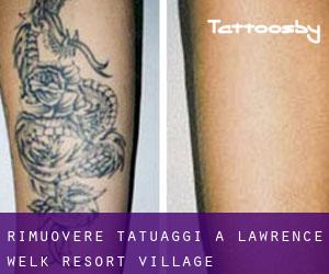 Rimuovere Tatuaggi a Lawrence Welk Resort Village