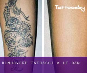 Rimuovere Tatuaggi a Le Dan