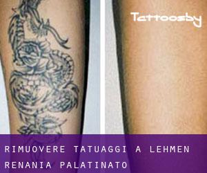 Rimuovere Tatuaggi a Lehmen (Renania-Palatinato)