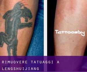 Rimuovere Tatuaggi a Lengshuijiang