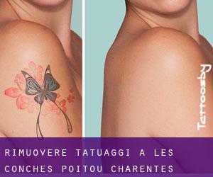 Rimuovere Tatuaggi a Les Conches (Poitou-Charentes)