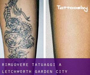 Rimuovere Tatuaggi a Letchworth Garden City
