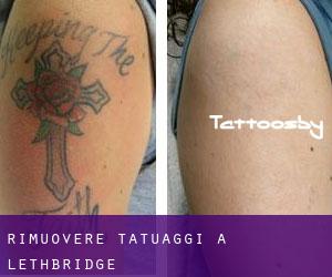Rimuovere Tatuaggi a Lethbridge