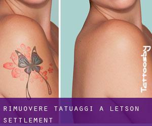 Rimuovere Tatuaggi a Letson Settlement