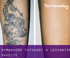 Rimuovere Tatuaggi a Lexington-Fayette