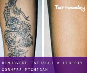 Rimuovere Tatuaggi a Liberty Corners (Michigan)