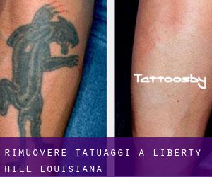 Rimuovere Tatuaggi a Liberty Hill (Louisiana)