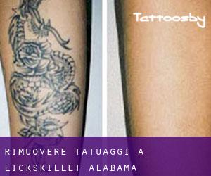 Rimuovere Tatuaggi a Lickskillet (Alabama)