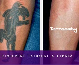 Rimuovere Tatuaggi a Limana