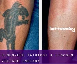 Rimuovere Tatuaggi a Lincoln Village (Indiana)