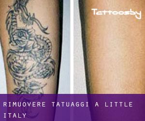 Rimuovere Tatuaggi a Little Italy