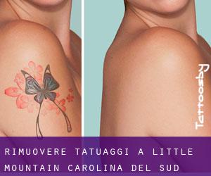 Rimuovere Tatuaggi a Little Mountain (Carolina del Sud)